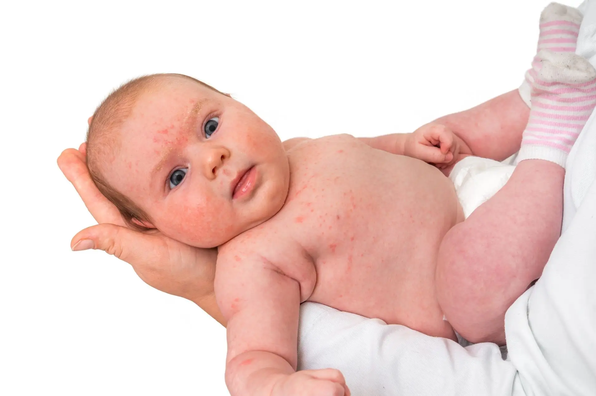 A imagem mostra um bebê de pele clara com brotoeja ou alergia, ou seja, erupção cutânea vermelha por todo o corpo e rosto, deitado no braço de uma pessoa. O bebê está usando meias listradas rosa e brancas, e a pessoa que o segura está vestindo uma camisa branca.