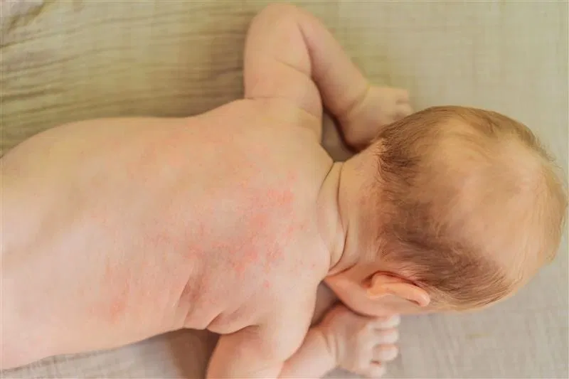 Brotoeja ou alergia? Aprenda a diferenciar - Blog Drogasmil - Dicas de  Saúde, Bem-Estar e Beleza
