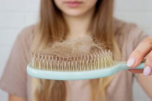 Queda de cabelo. Pessoa segurando uma escova de pentear com alguns fios de cabelo sobre ela.