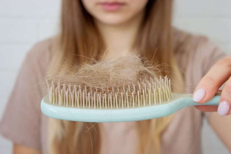 Queda de cabelo. Pessoa segurando uma escova de pentear com alguns fios de cabelo sobre ela.